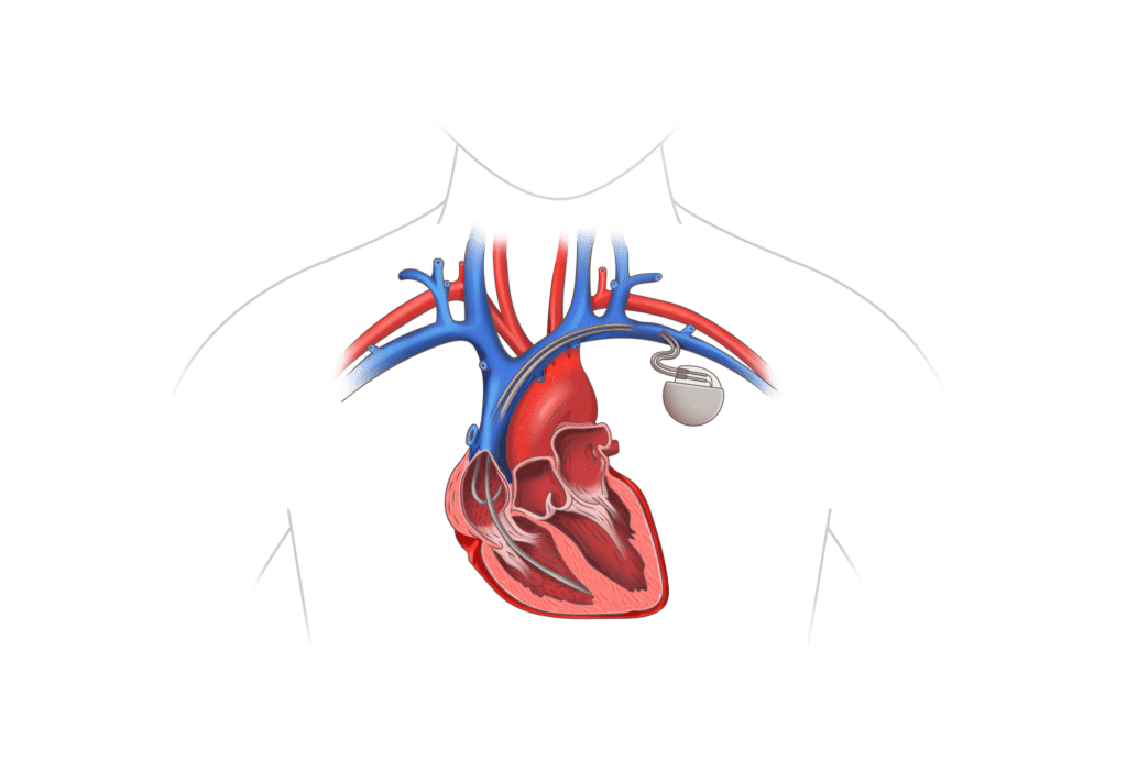 Heart and pacemaker